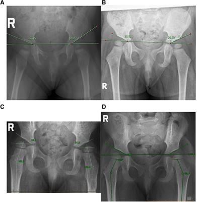 Case report: Morphological changes evident after manual therapy in two cases of late-diagnosed developmental dysplasia of the hip